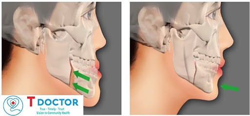 Gãy xương hàm dưới bao lâu thì lành, hỏi đáp cùng Tdoctor